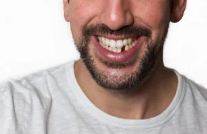 guy with missing tooth
